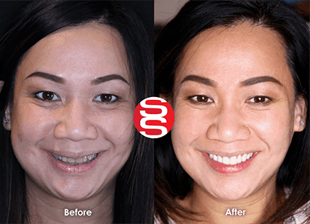 Porcelain Veneers